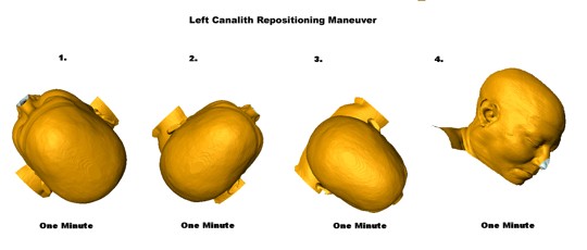 Left Canalith Repositioning Maneuver