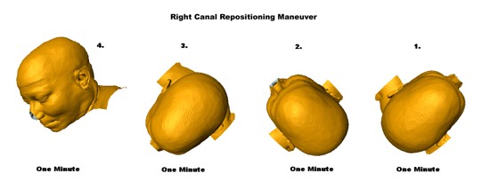 Right Canalith Repositioning Maneuver