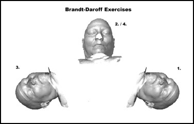 Brandt-Daroff exercises