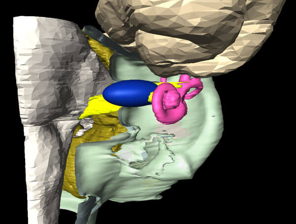 Small Acoustic Neuroma: This neuroma fills the internal auditory canal and is protruding into the space between the bone and the brainstem. It is still far from the brainstem(WHITE) and cerebellum(GOLD). Excellent treatment results can be expected from both radiation and microsurgery in experienced hands.