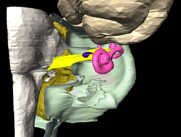 Tiny Acoustic Neuroma: This illustration shows a tiny acoustic neuroma(BLUE) within the internal auditory canal which carries the hearing, balance and facial nerves(YELLOW). Such small tumors may be incidental and it is reasonable to wait for tumor growth or progression of hearing loss before treatment.