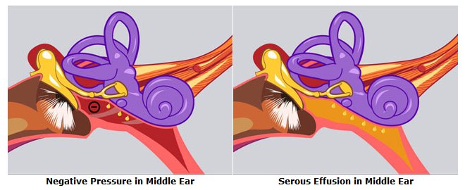 Negative Pressure in Middle Ear 	Serous Effusion in Middle Ear