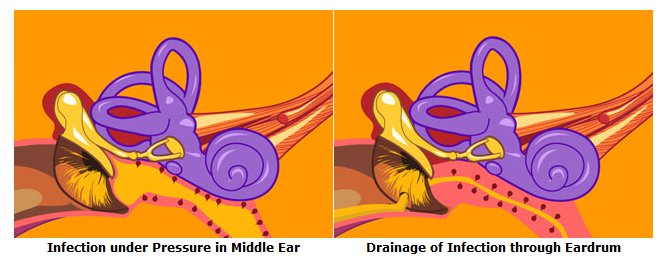 Infection under Pressure in Middle Ear 	Drainage of Infection through Eardrum