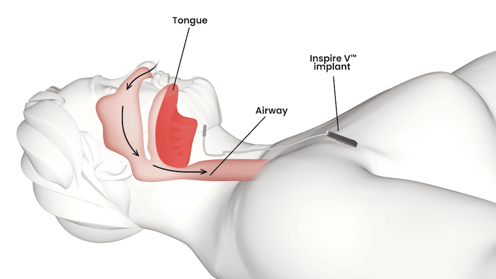 Illustration of how an Inspire implant works with your airway